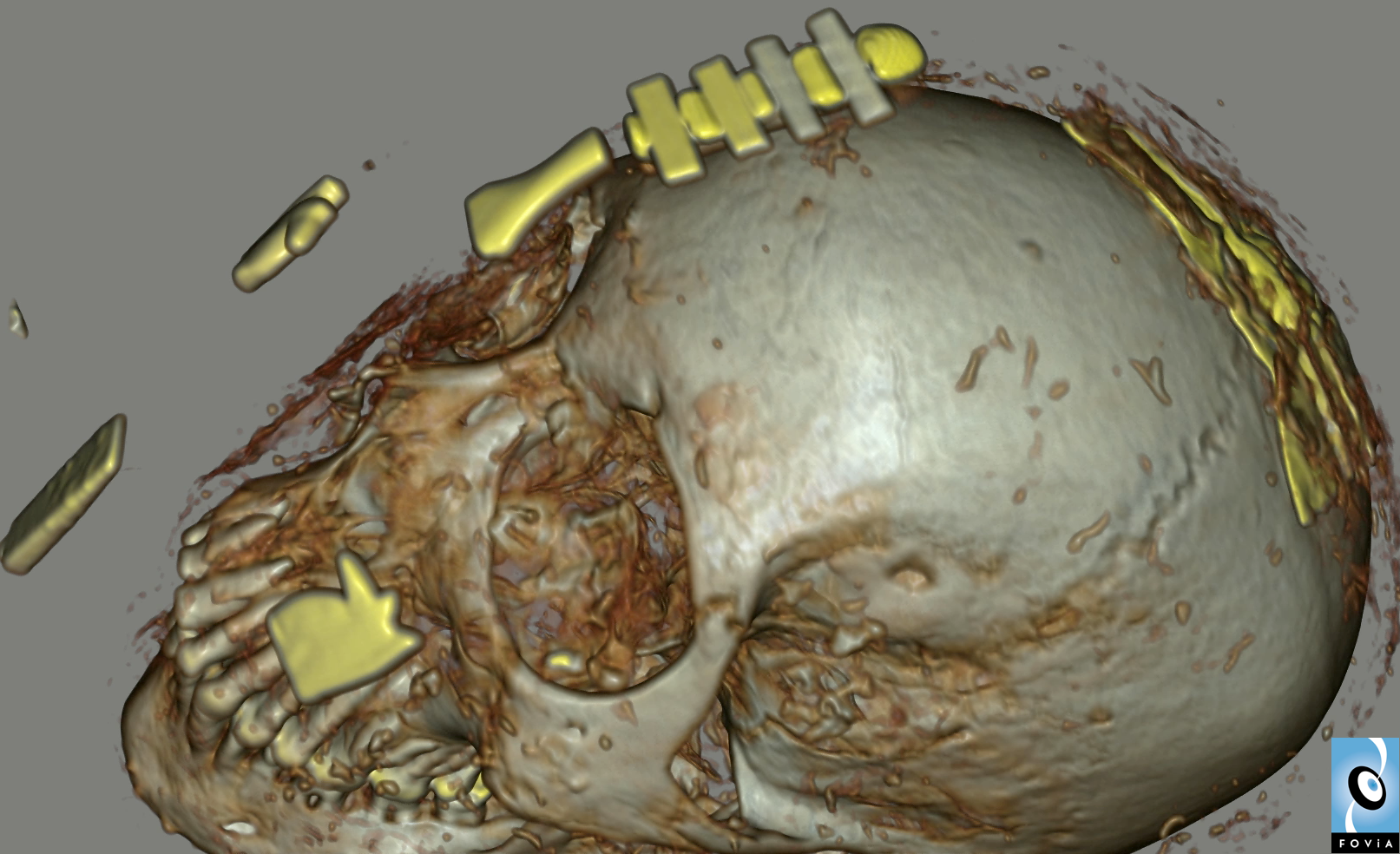 Scotland Mummy Cranial View