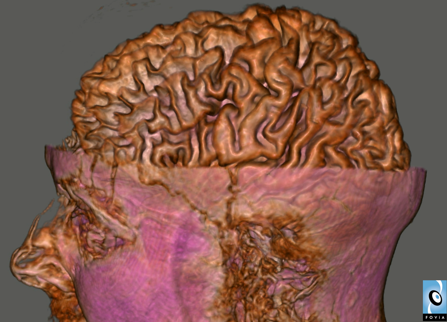 Brain MRI