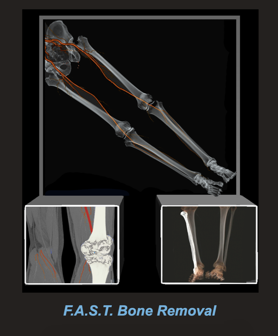 F.A.S.T. Bone Removal