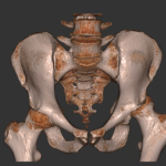 Left-hip-dislocationsmall